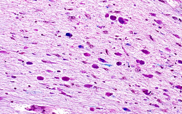 1F4 Metachromatic Leukodystrophy (Case 1) cerebellum 9823 40X