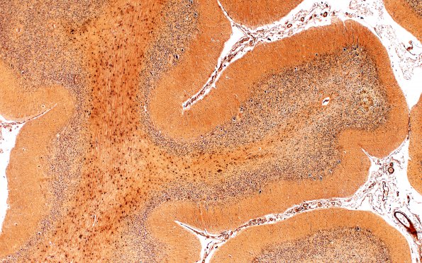 1F5 Metachromatic Leukodystrophy (Case 1) cerebellum 9822 4X