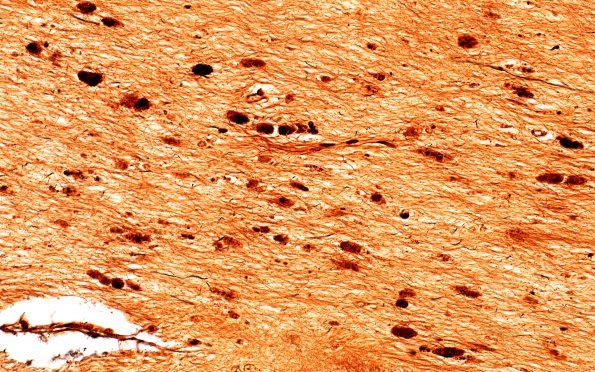 1F6 Metachromatic Leukodystrophy (Case 1) cerebellum 9825 40X