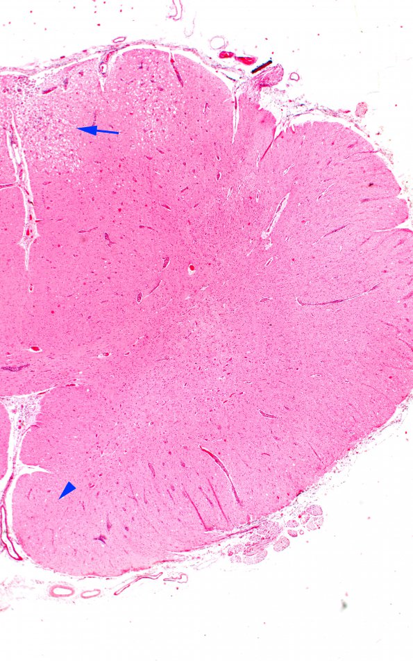 1G1 Metachromatic Leukodystrophy (Case 1) spinal cord 9798 copy