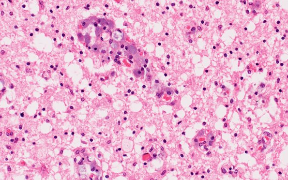 1G10 (Case 1) Area A Spinal cord H&E 40X