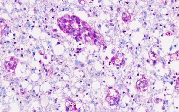 1G11 (Case 1) Area A Spinal cord LFB-PAS 40X