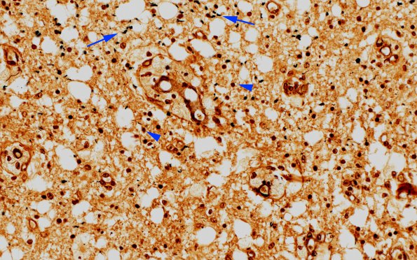 1G12 (Case 1) Area A Spinal cord Biels 40X copy