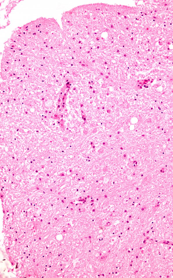 1G2 Metachromatic Leukodystrophy (Case 1) spinal cord 9800 20X