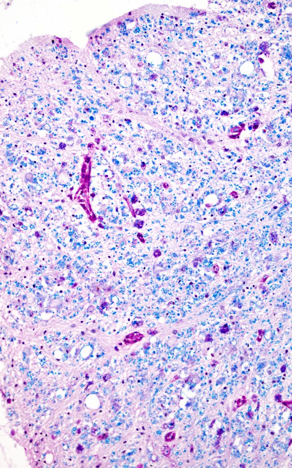 1G3 Metachromatic Leukodystrophy (Case 1) spinal cord 9799 20X