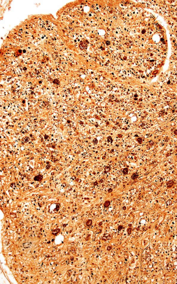 1G4 Metachromatic Leukodystrophy (Case 1) spinal cord 9798 20X