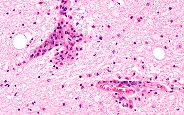 1G5 Metachromatic Leukodystrophy (Case 1) spinal cord 9802