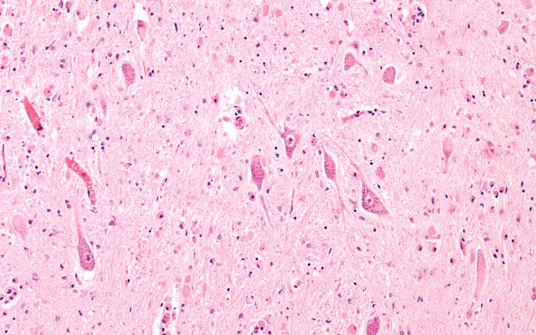 1G6 Metachromatic Leukodystrophy (Case 1) spinal cord 9803