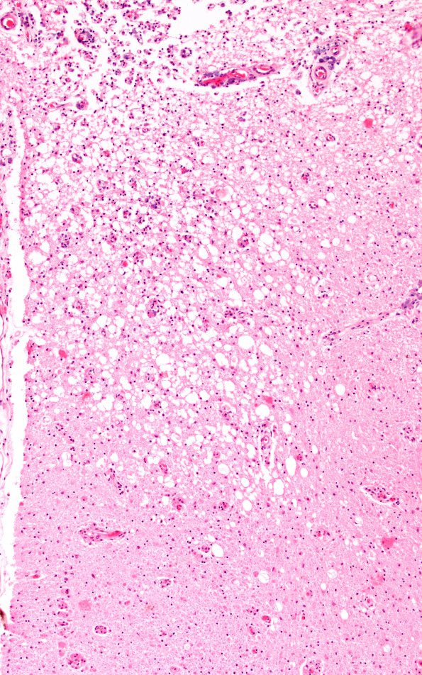 1G7 Metachromatic Leukodystrophy (Case 1) spinal cord 9795