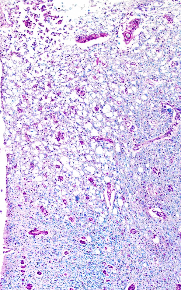 1G8 Metachromatic Leukodystrophy (Case 1) spinal cord 9805 10X