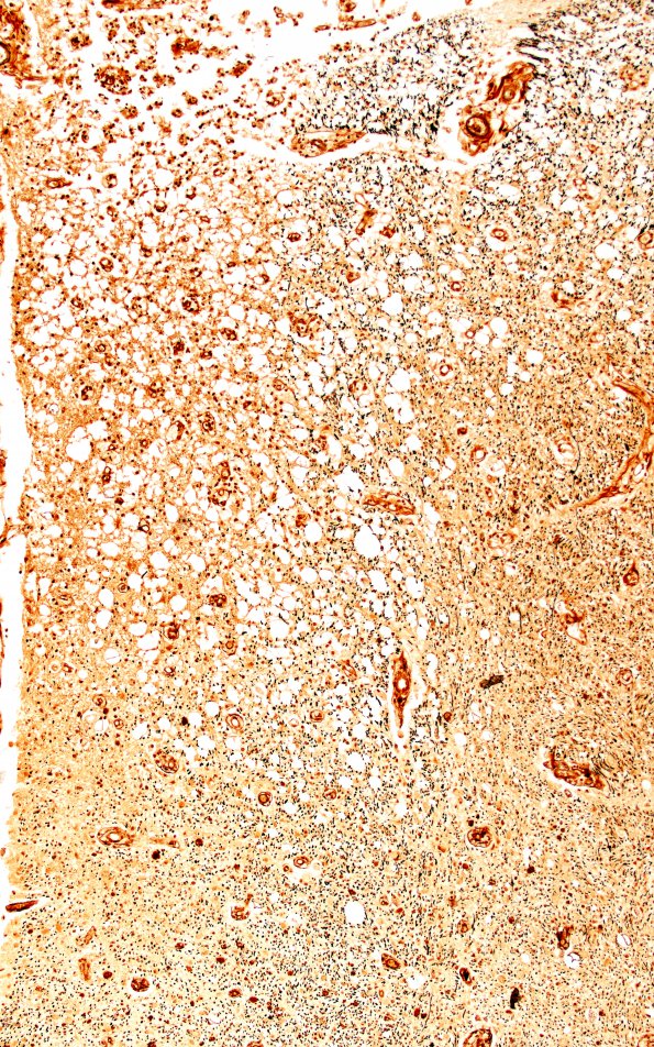 1G9 Metachromatic Leukodystrophy (Case 1) spinal cord 9794