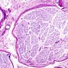 1H1 MLD (Case 1) 1 LFB-PAS sural nerve LFB-PAS 10X 1