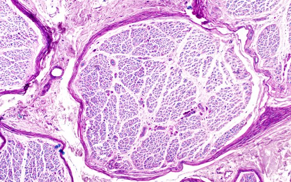 1H1 MLD (Case 1) 1 LFB-PAS sural nerve LFB-PAS 10X 1