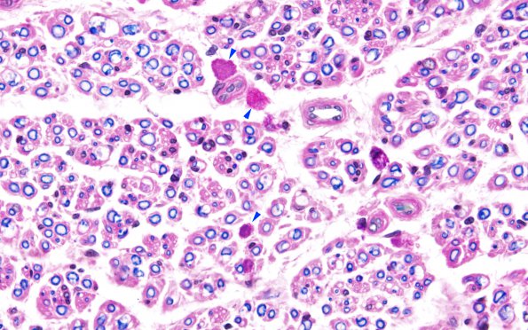 1H2 MLD (Case 1) 1 LFB-PAS sural nerve LFB-PAS 20X 1 copy