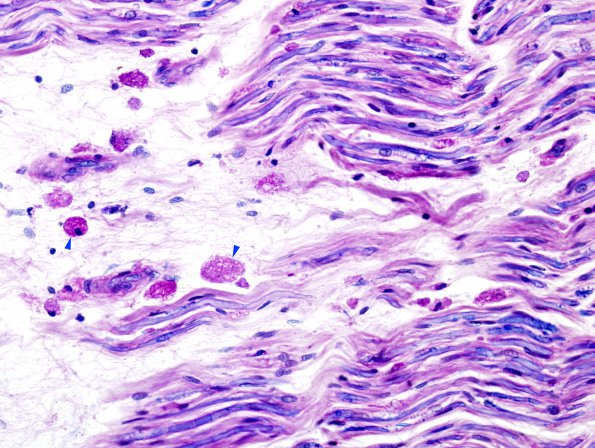 1H3 Metachromatic Leukodystrophy (Case 1) LFB-PAS sural copy