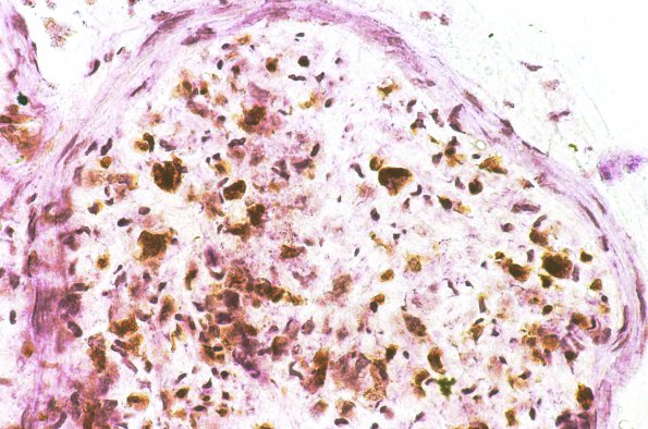 1I Metachromatic Leukodystrophy (Case 1) Hirsch-Peiffer 2 A