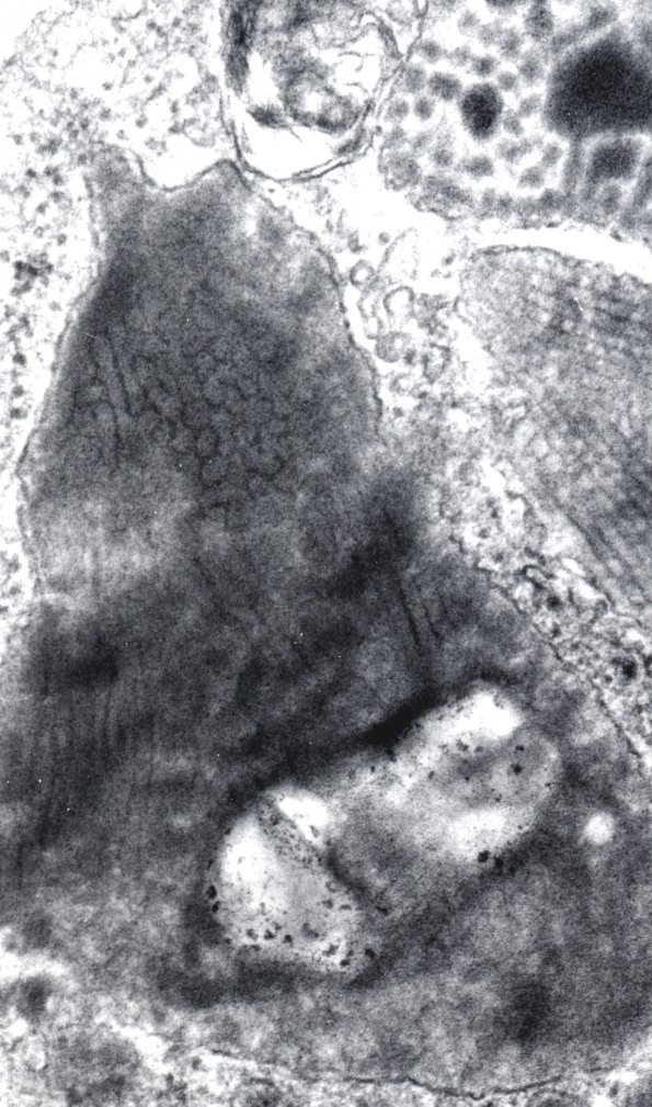 1J Metachromatic Leukodystrophy (Case 1) EM - Copy