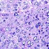 2A3 Metachromatic Leukodystrophy (Case 2) Plastic 3 copy