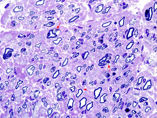 2A3 Metachromatic Leukodystrophy (Case 2) Plastic 3 copy