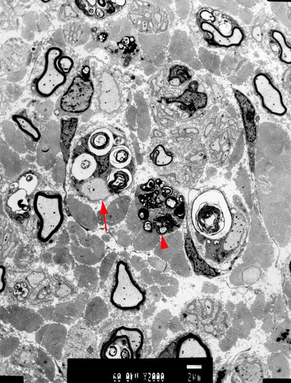 2B1 MLD (Case 2) Metachromatic Leukodystrophy - 2000X copy - Copy