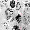 2B2 MLD (case 2) Sural Nerve EM 5 copy - Copy