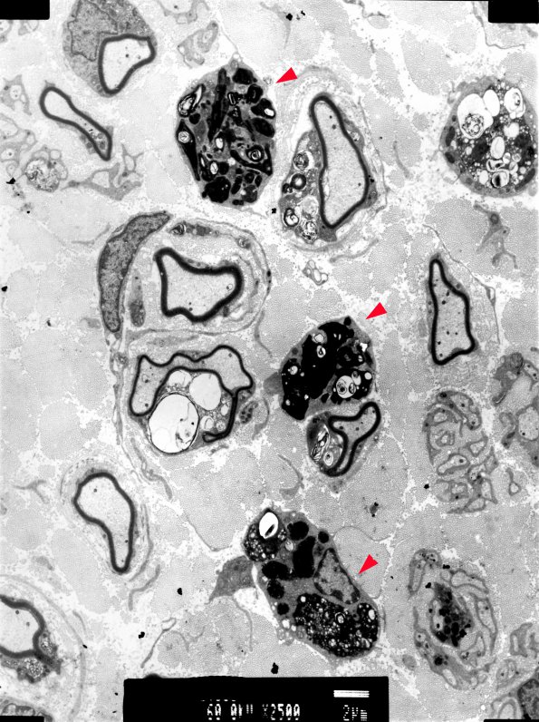 2B2 MLD (case 2) Sural Nerve EM 5 copy - Copy