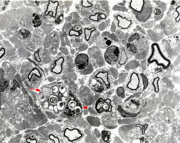 3B MLD, sural nerve (Case 3) EM 1 copy - Copy