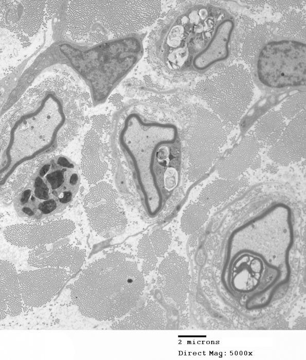 3C1 MLD (Case 3) Nerve  2_029A - Copy