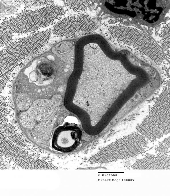 3C2 MLD (Case 3) Nerve  2_069A - Copy