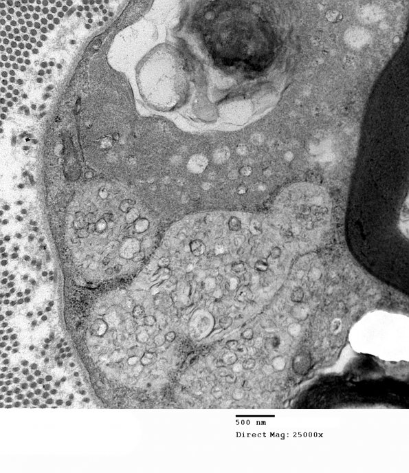 3C3 MLD (Case 3) Nerve  2_070A - Copy