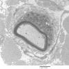 3C4 MLD (Case 3) Nerve  2_020A - Copy