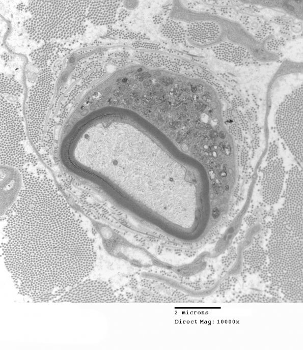 3C4 MLD (Case 3) Nerve  2_020A - Copy