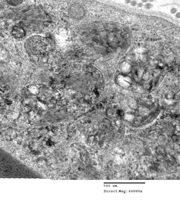 3C5 MLD (Case 3) Nerve  2_022 - Copy