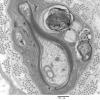 3C6 MLD (Case 3) Nerve  2_087A - Copy