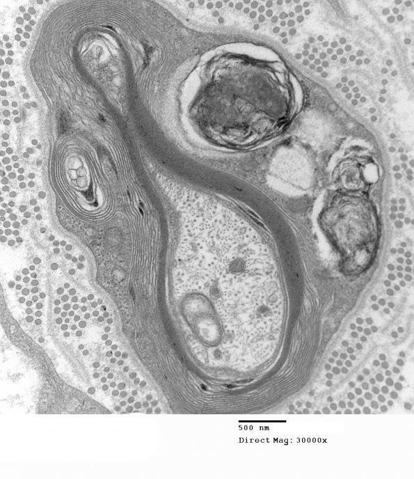 3C6 MLD (Case 3) Nerve  2_087A - Copy