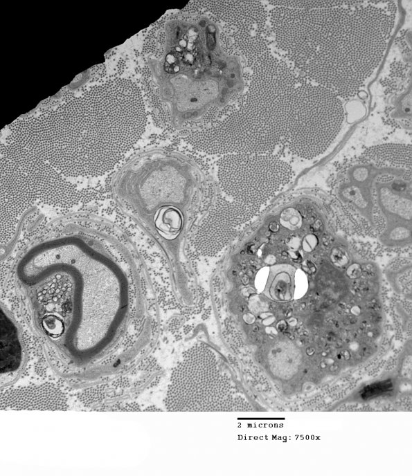 3D2 MLD (Case 3) Nerve  2_025A - Copy