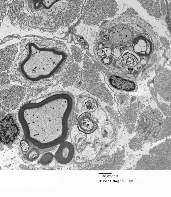 3D3 MLD (Case 3) Nerve  2_077A - Copy