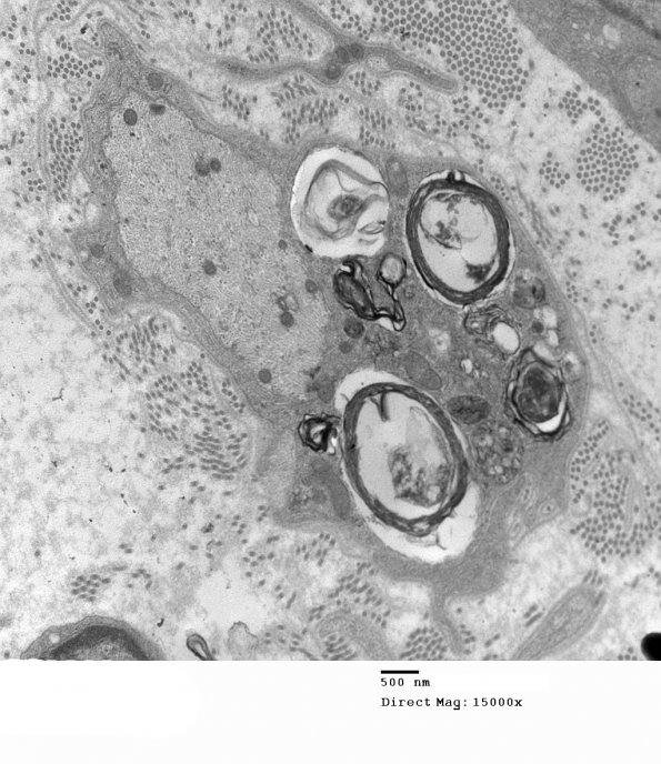 3D4 MLD (Case 3) Nerve  2_012A - Copy