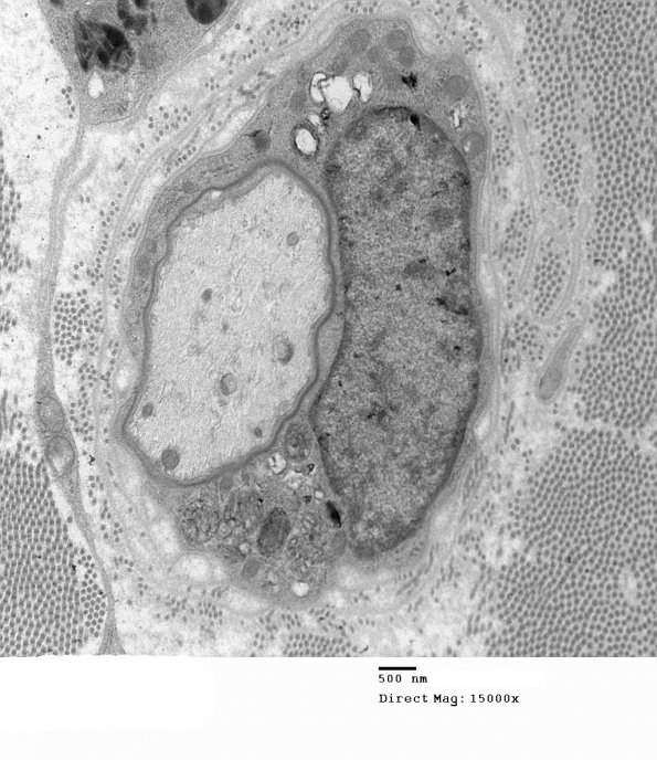 3D5 MLD (Case 3) Nerve  2_039 - Copy