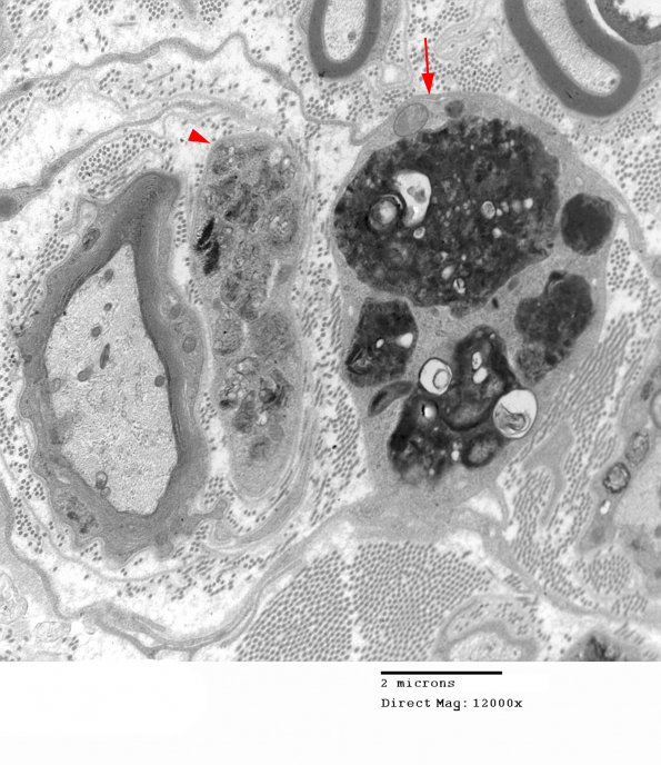 3D6 MLD (Case 3) Nerve  2_009 copy - Copy