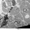 3E1 MLD (Case 3) Nerve  2_118A - Copy