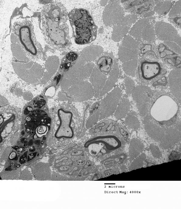 3E1 MLD (Case 3) Nerve  2_118A - Copy