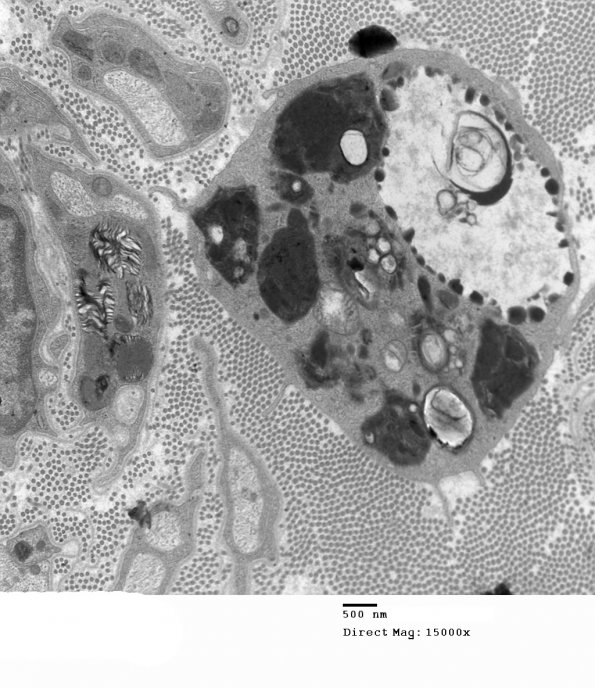 3E2 MLD (Case 3) Nerve  2_011 - Copy