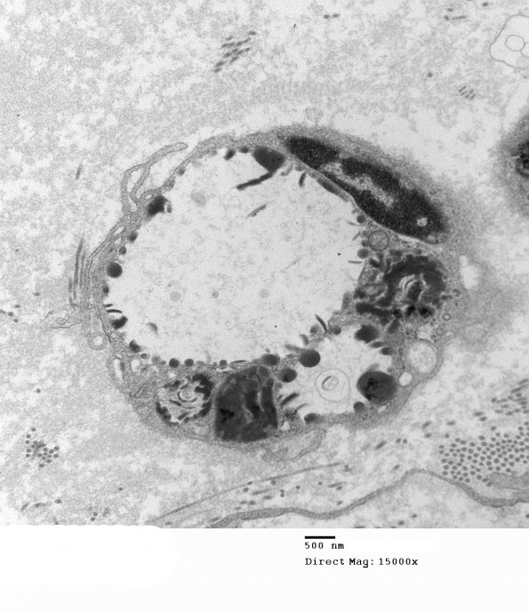 3E3 MLD (Case 3) Nerve  2_114 - Copy