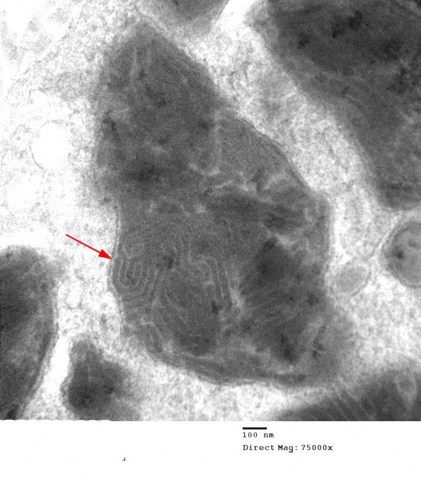 3E4 MLD (Case 3) Nerve  2_031a copy - Copy