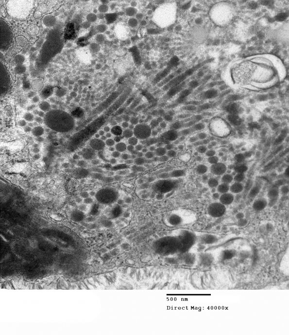 3E6 MLD (Case 3) Nerve  2_115AA - Copy