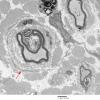 3F1 MLD (Case 3) Nerve  2_019A copy - Copy