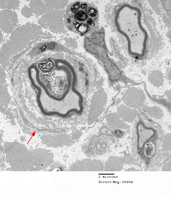 3F1 MLD (Case 3) Nerve  2_019A copy - Copy