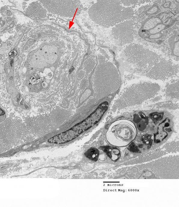 3F2 MLD (Case 3) Nerve  2_079A copy - Copy