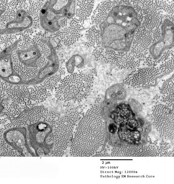 4D MLD (Case 4) EM 112 - Copy